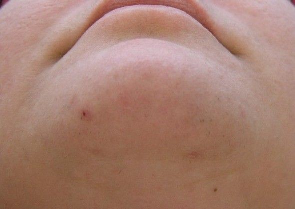 Home Remedies to Remove Hair Under the Chin Perman...