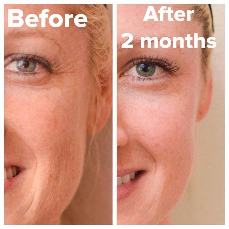 Say goodbye to freckles and fine lines. Improve th...