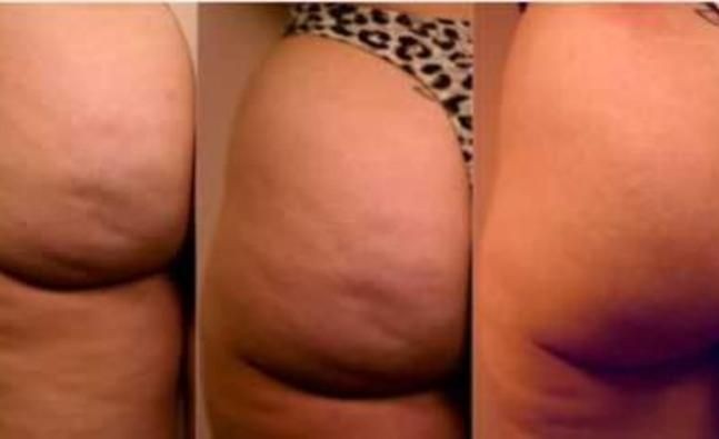 Home remedies to beat cellulite - Cellulite Remova...