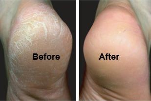 Soften and Get Rid of Tough Calluses: blend two ta...
