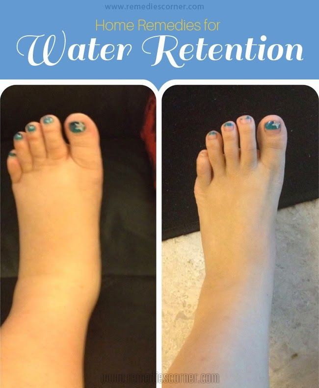 Home Remedies for Water Retention | Remedies Corne...