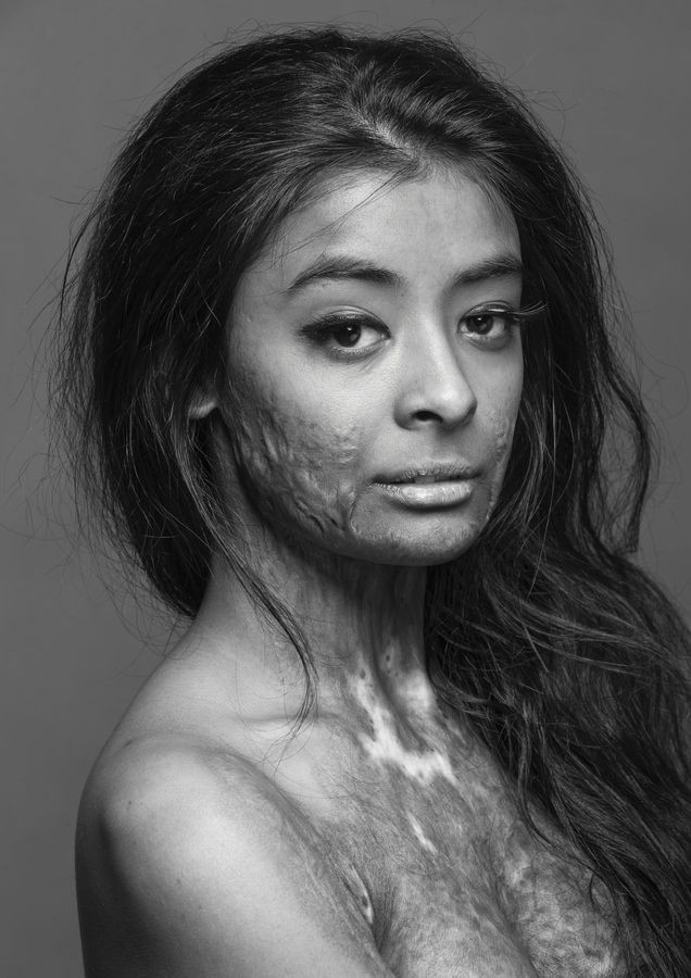 This beautiful model, a burn survivor, did this ph...