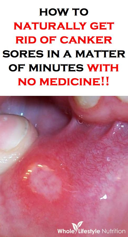 How To Naturally Get Rid of Canker Sores In Minute...