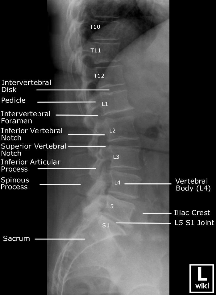Radiographic Anatomy - Lumber Spine Lateral
